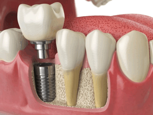 Dental Implants Valley Village